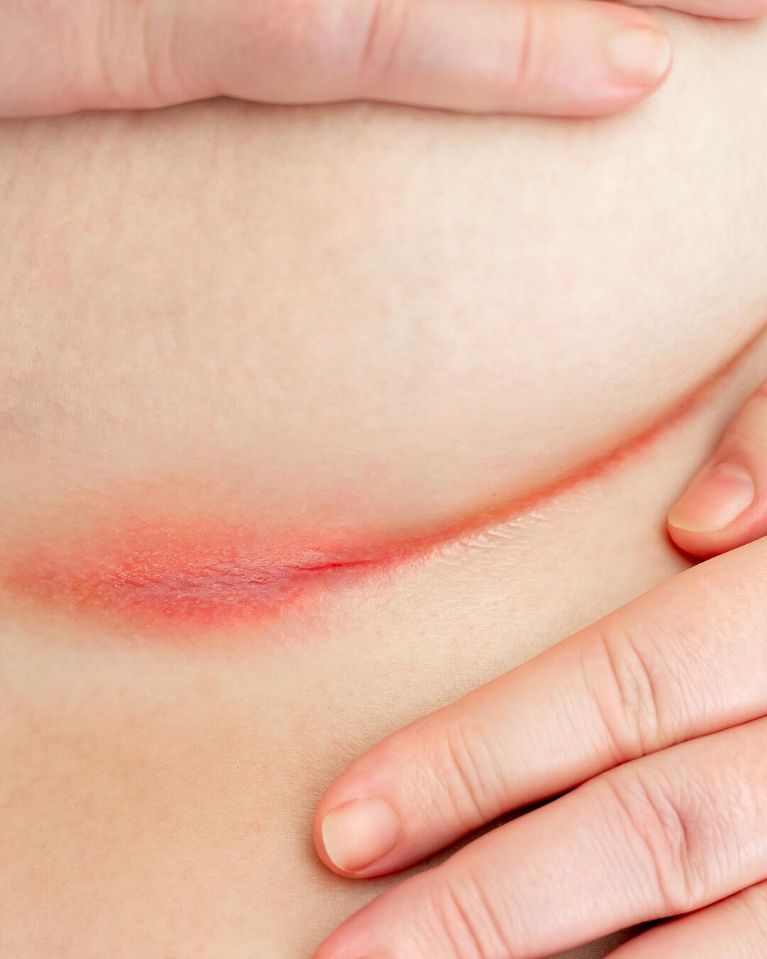 intertrigo mage-fold